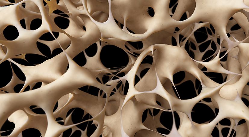 پوکی استخوان | از علائم تا راه‌های پیشگیری و درمان