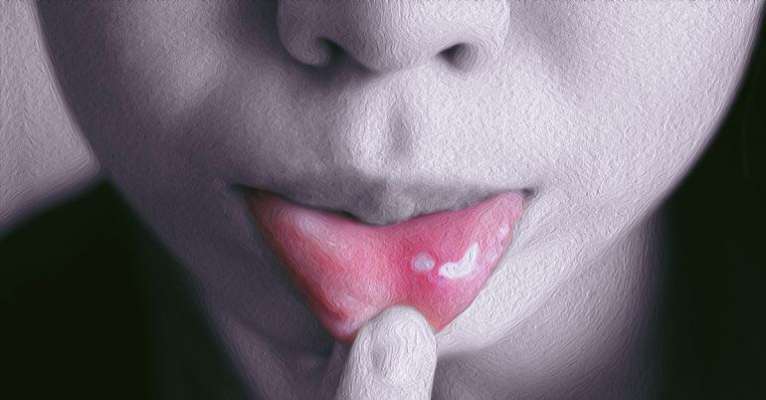 درمان آفت دهان