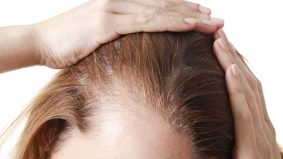چربی موی سر ؛ از علل تا درمان