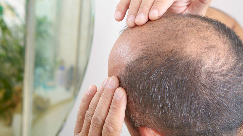راهکارهای جلوگیری از ریزش مو - علت ریزش مو چیست؟