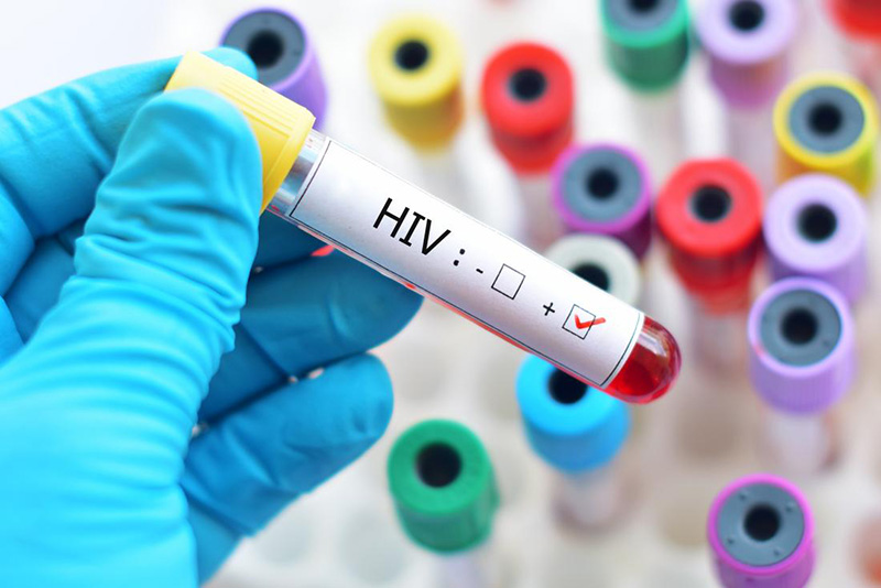 بیماری ایدز (HIV) چیست از علائم تا راه‌های انتقال و درمان