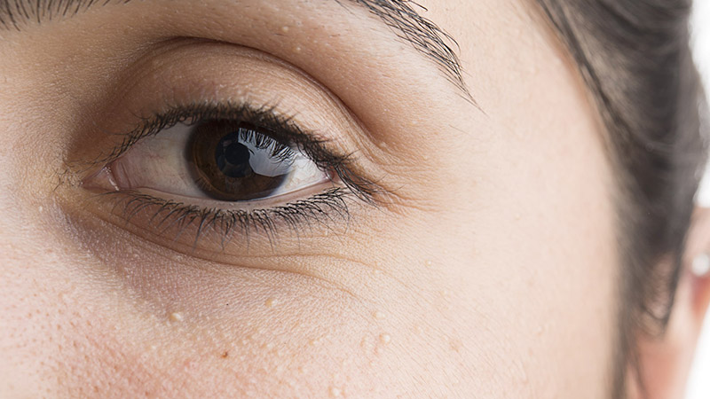 آلوئه‌ورا با داشتن خاصیت ضدالتهابی به کاهش گودی زیر چشم کمک می‌کند.